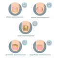 Types of onychomycosis of nails.